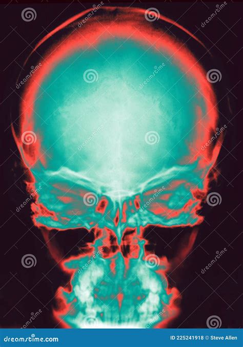 Human Skull X Ray Stock Photo Image Of Healthcare 225241918