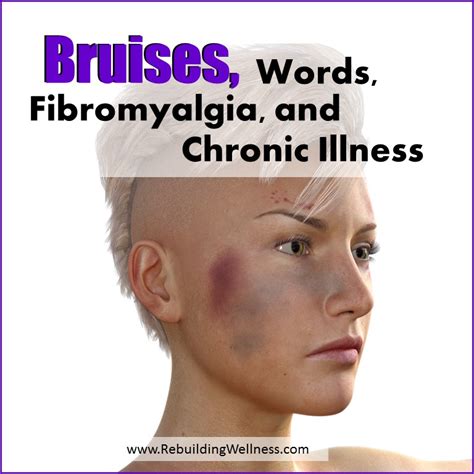 Bruises Words Fibromyalgia And Chronic Illness Rebuilding Wellness