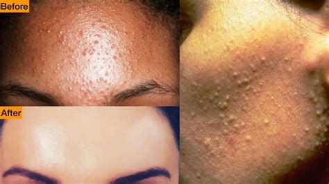 Get Rid Of Tiny Bumps On Face Simple Home Remedy Mamtha Nair