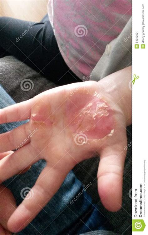 Burn On Childs Hand Stock Image Image Of Hand Burn 54319601