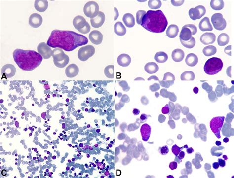 Common in children with darker corticosteroid ointments with either sauna suits or as part of soak and smear (a regimen in which the patient soaks in a plain water bath followed by an. Photomicrography of the peripheral blood smear A, B -and ...