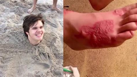 Mom Son Infected By Hookworm At Broward Beach