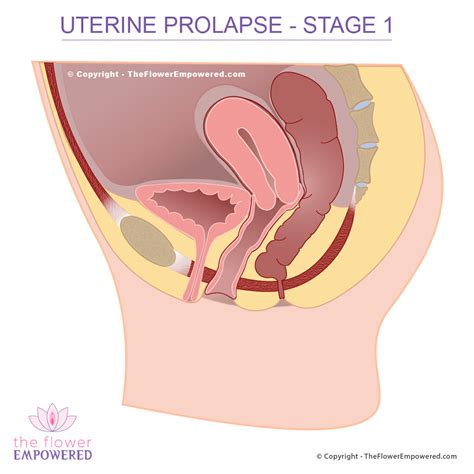 Uterine Prolapse Prolapsed Uterus Pelvic Organ Prolapse Stage 0 To 4