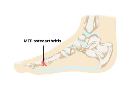 1st Metatarsophalangeal Joint Osteoarthritis Archives Total Care Podiatry