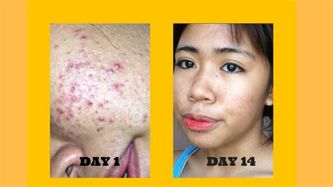 Dermcare Acne Treatment Youtube