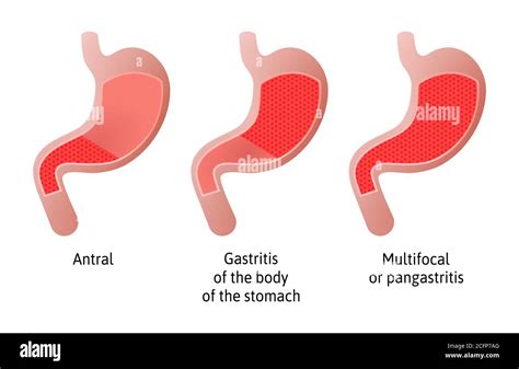 Lage Der Gastritis Eine Entzündung Der Magenschleimhaut Drei Typen