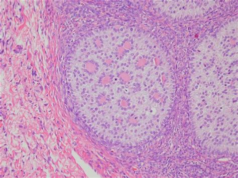 pathology outlines sex cord tumor with annular tubules