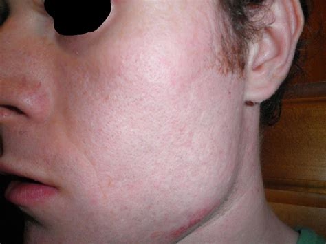 Advice On Treatment For Scars And Red Marks On Face Hyperpigmentation
