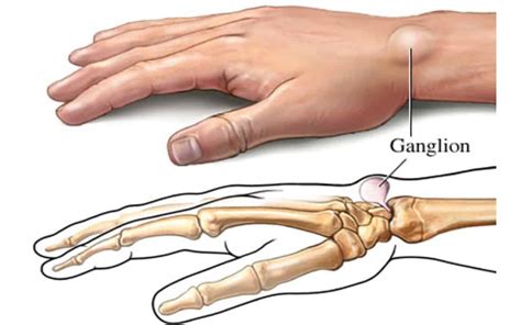 Ganglion Cyst Mississauga Chiropractor And Physiotherapy Clinic