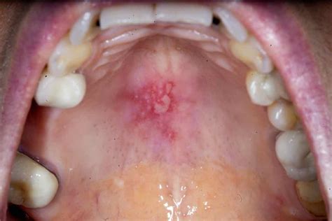 What Causes Sores On The Roof Of Your Mouth Home Interior Design