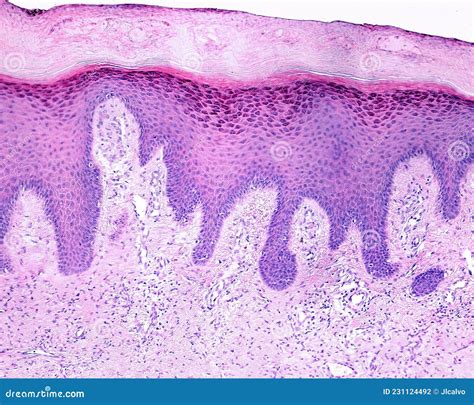 Human Skin Lichen Planus Stock Photo Image Of Biological 231124492