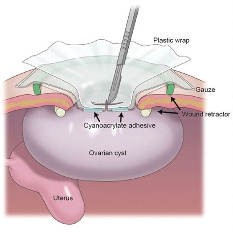 Frontiers Modified Leak Proof Puncture Technique For The Aspiration Of Giant Ovarian Cysts By