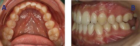 Impacted First And Second Permanent Molars Overview Intechopen