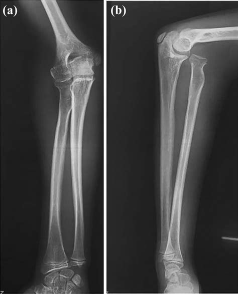 Step Cut Osteotomy In Neglected Monteggia Fracture Dislocation In