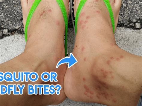 Difference Between Spider Bite And Mosquito Bite Captions Hangout