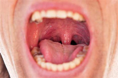 Natural Ways To Heal Burned Roof Of The Mouth — Healthy Builderz