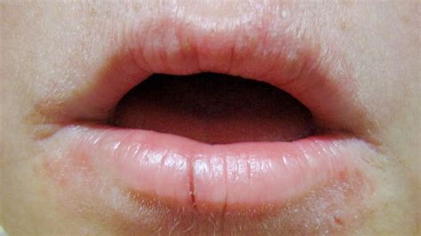 What Causes Red Ring Around Lips
