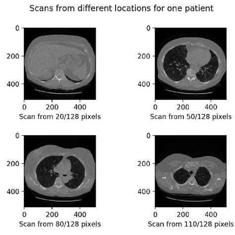 2d Ct Scan Slice Containing A Small 5mm Early Stage Lung Cancer