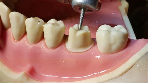 Molar Crown Preparation Walkthrough Tutorial In The Simulation Lab