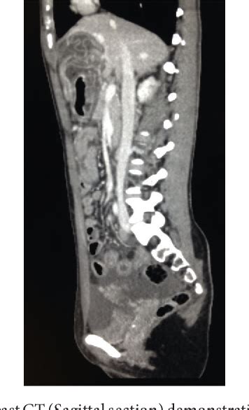 Figure 1 From Spontaneous Intraperitoneal Rupture Of A Hepatic Hydatid