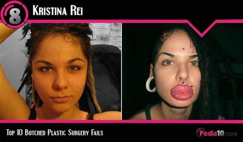 Top Botched Plastic Surgery Fails Before And After Tor Pussic
