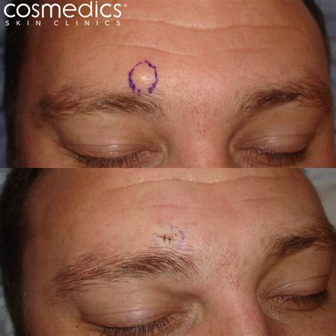 Cyst Removal London Surgical Treatment Cosmedics Skin Clinics