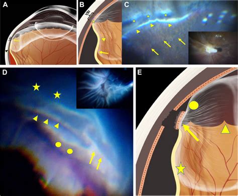 Multimodal Imaging Of A Micro Anatomical Structure In The Vitreous Base