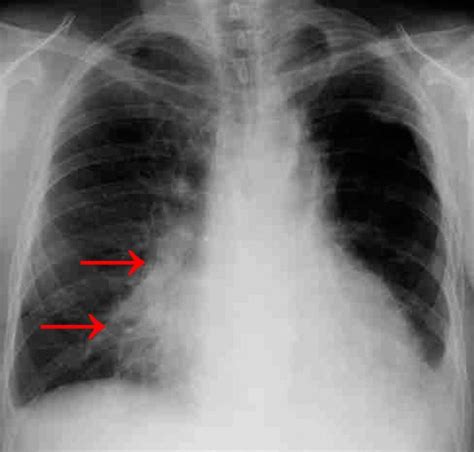 Pneumonia X Ray Pictures