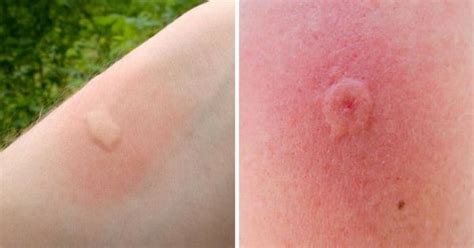 12 Common Bug Bites And How To Recognize Each One Insect Bites Bug