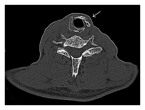 Ct Scan Showing Cricoid Cartilage Invasion By Thyroid Carcinoma Arrow