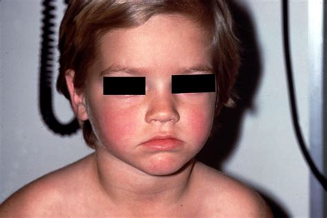 Parvovirus B19 Slapped Cheek Rash Paeds Fifth Disease Healthy