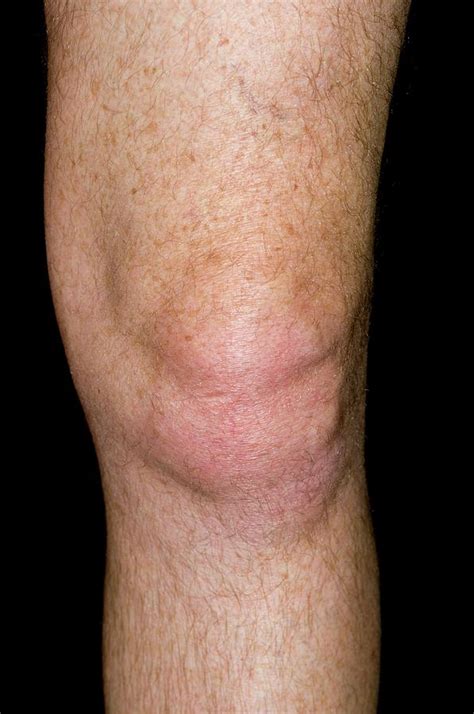 Causes Of Gout In Knee GoutInfoClub Com