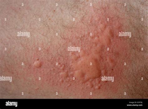 Urticaria Rash Also Known As Nettle Rash Or Hives Caused By A Food