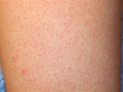 How To Improve Chicken Skin Keratosis Pilaris Musely