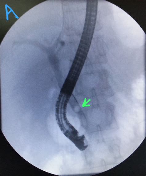 Ercp And Egd Cbd Stone Removal Prior To Cholecystectomy