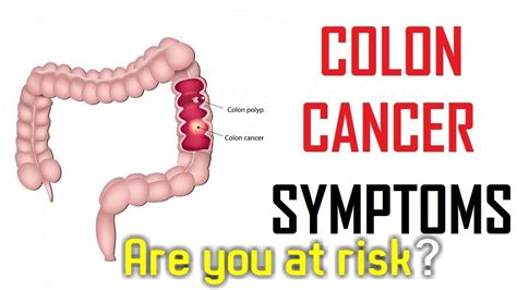 Symptoms Of Bowel Cancer To Be Aware Of Are You At Risk Youtube