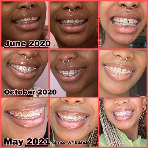 My First Full Year In Braces I Was Sad To Lose My Gap But Im Liking How My New Smile Is