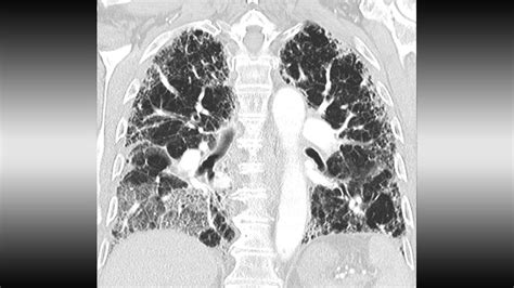 Idiopathic Pulmonary Fibrosis 5 Things To Know