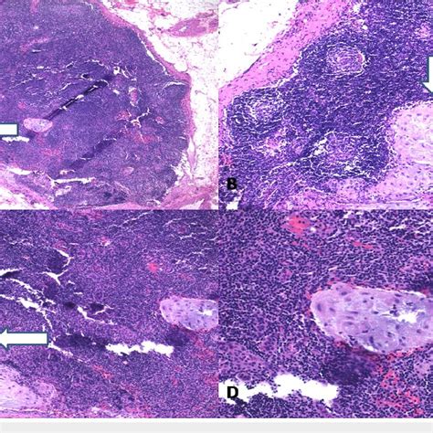 Pdf Decidualized Stroma In Pelvic Lymph Nodes In A Pregnant Patient