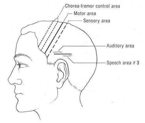 Acupuncture For Parkinsons Tremor