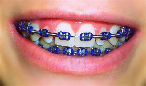 What Services Do Orthodontics In Canberra Provide Cute Braces Colors