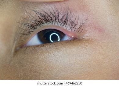 Close Upper Eyelid Abscess Stye Hordeolum Stock Photo Shutterstock
