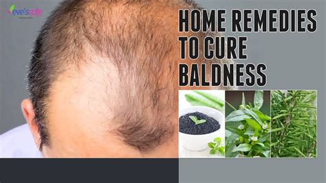 How To Treat Baldness Or Regrow Hair On Bald Spot Home Remedy Youtube