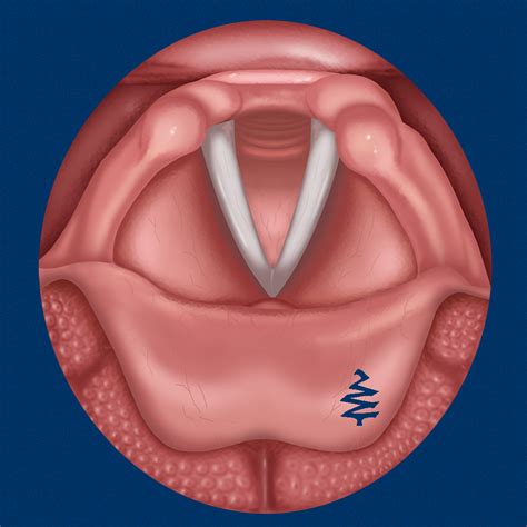 About Vocal Folds Id Ios App Store Version Apptopia