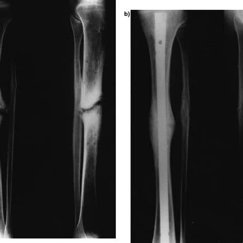 A Segmental Tibial Fracture Initial Treatment With External