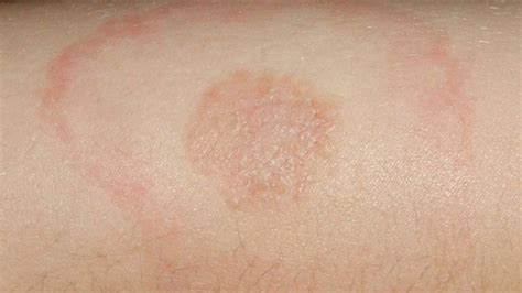 Erythema Migrans Vs Erythema Multiforme