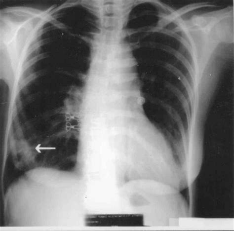 Chest X Ray Showing A Consolidation At The Base Of The Right Lung