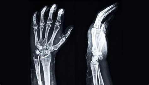 Wrist X Ray Anatomy Procedure And What To Expect