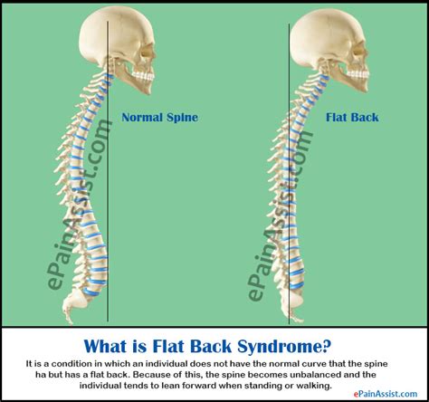 Flat Back Syndromecausestreatmentexercisesdiagnosis