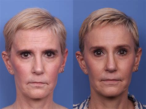 Facial Reconstruction Before And After Pictures Case 218 Scottsdale